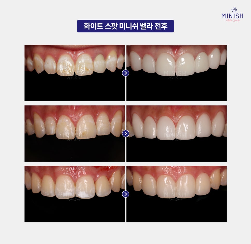 White Spots on Teeth: Worried About White Stains on Your Teeth? Here’s How to Improve Them Healthily! image 6