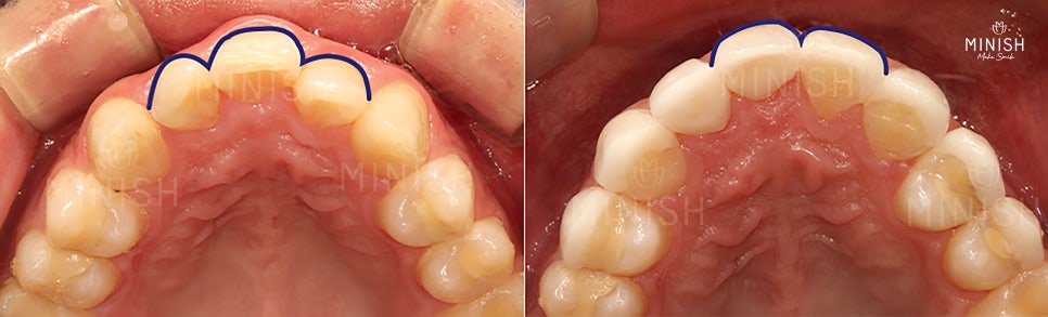 The front teeth I had worried about because of missing teeth, transformed healthily with MINISH image 6