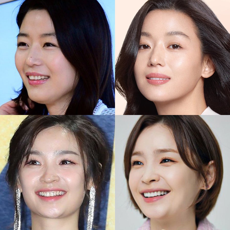 교정 후 벌어진 앞니와 블랙트라이앵글, 논현동 미니쉬치과병원에서 해결 관련 이미지 7