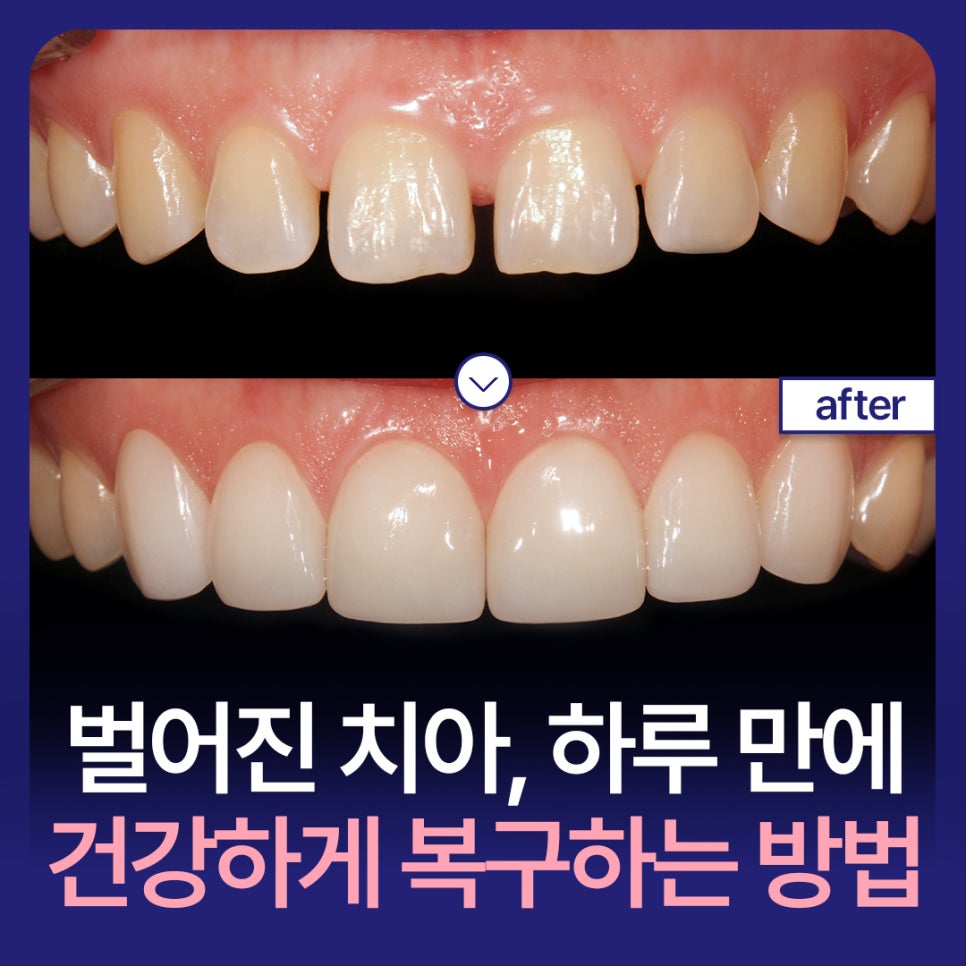 How to Restore Gapped Teeth Healthily in Just One Day image 1