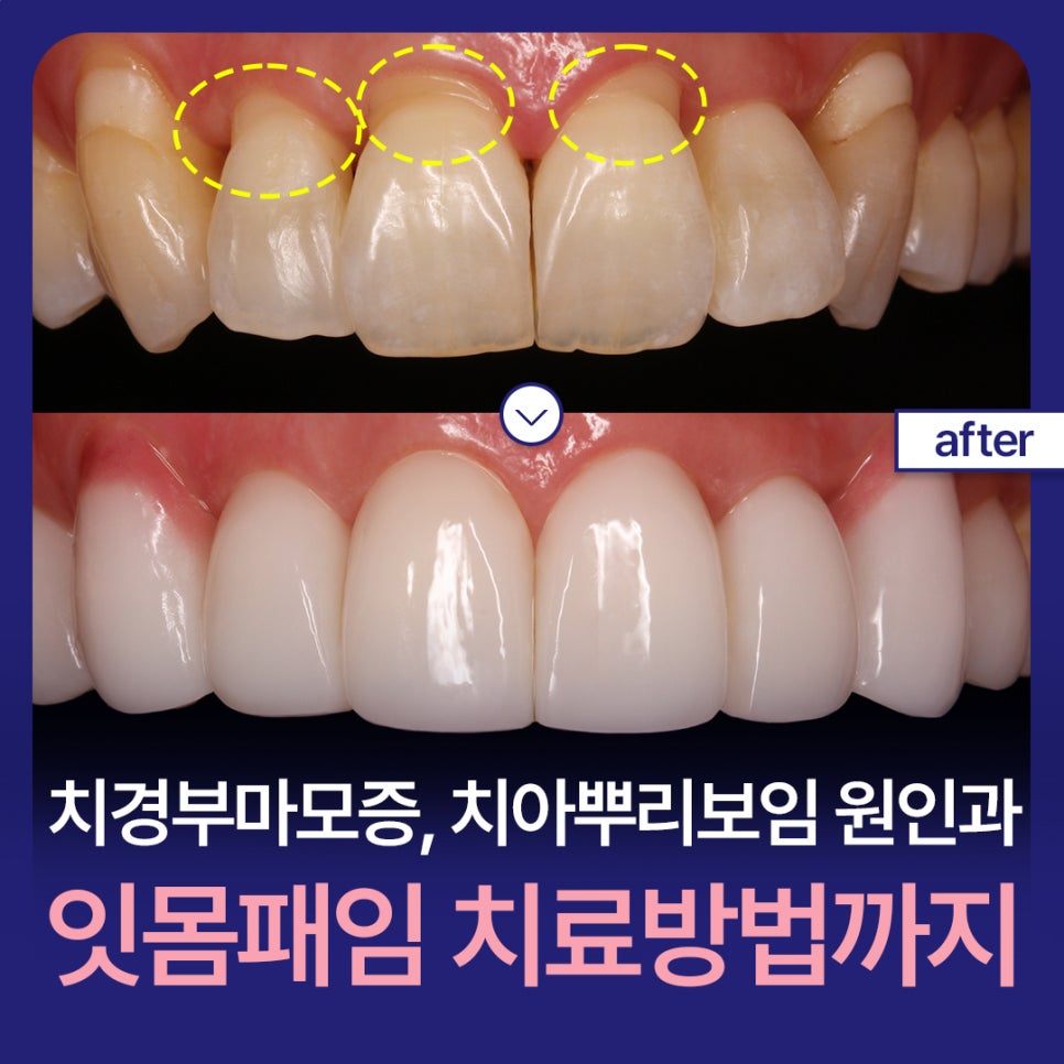 Cervical Abrasion, Causes of Exposed Tooth Roots, and Treatment for Gum Indentations image 1