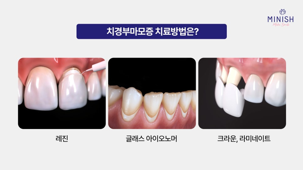 Relieve Tooth Sensitivity Caused by Cervical Abrasion with Pink Minishe image 5