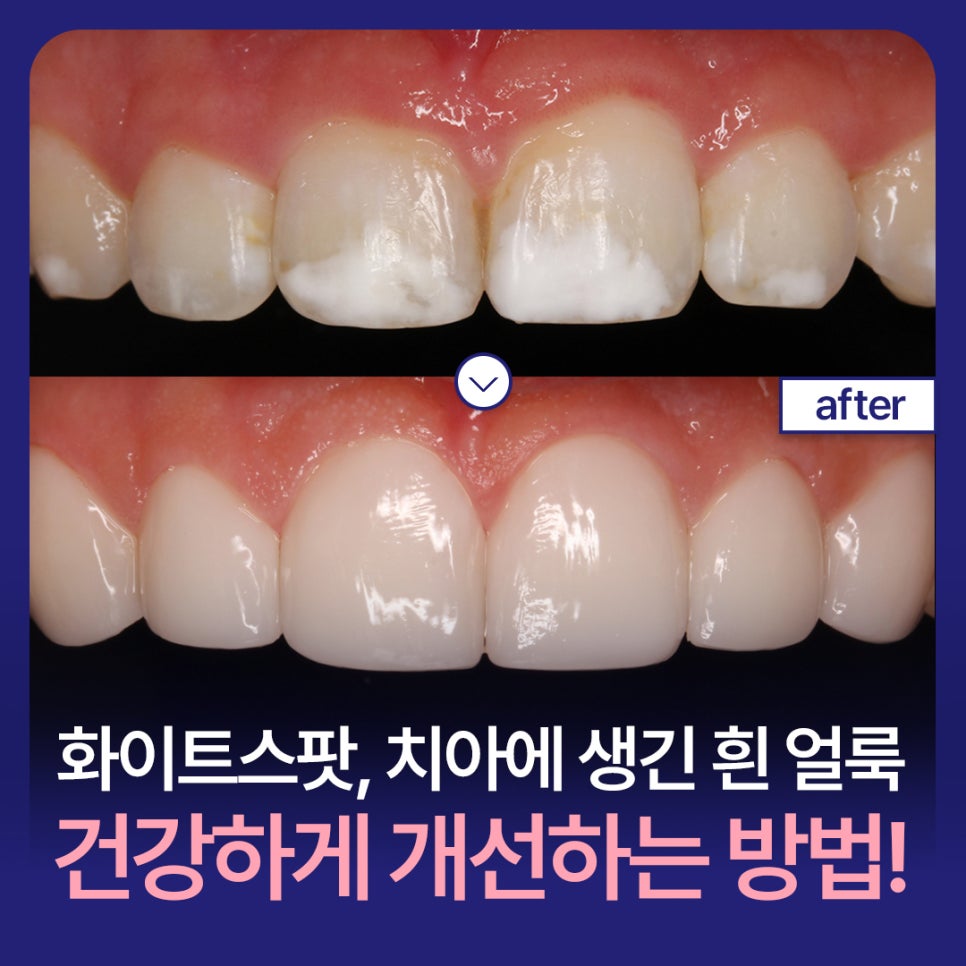 White Spots on Teeth: Worried About White Stains on Your Teeth? Here’s How to Improve Them Healthily! image 1