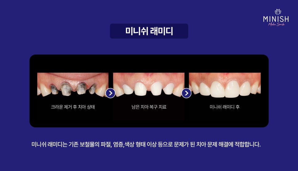 A Complete Guide to the Minish Program That Fits My Teeth image 5