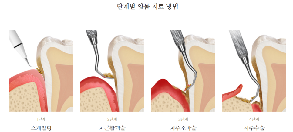 잇몸 내려앉음, 잇몸퇴축 원인과 치료 방법은? 관련 이미지 4