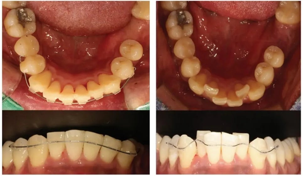 Orthodontics Without Tooth Reduction! Pre Align image 3