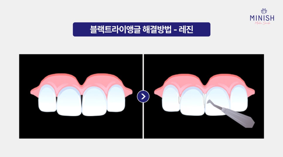 Black Triangles Between Teeth: What Causes Black Triangles and How Can They Be Resolved? image 5