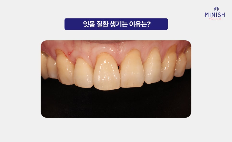 If You Miss the Warning Signs of Gum Disease, It Becomes Hard to Reverse. What Is the Right Treatment Method? image 2