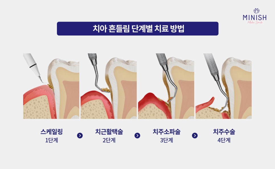 강남구청역치과 치아 흔들림 원인, 방치하면 생기는 변화 관련 이미지 5