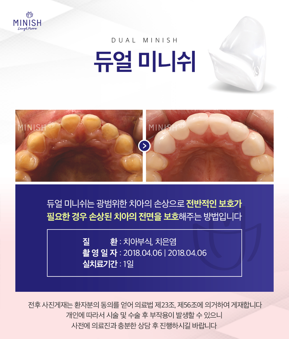 미니쉬부작용 시린감? 되려 시린이치료에도 도움이 되는 미니쉬솔루션을 소개합니다 관련 이미지 4