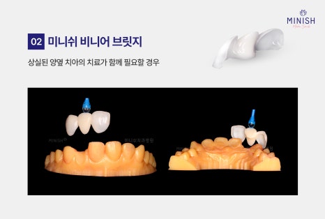 치아 브릿지 vs 미니쉬 브릿지 : 내 치아를 지키는 최적의 선택은? 관련 이미지 5