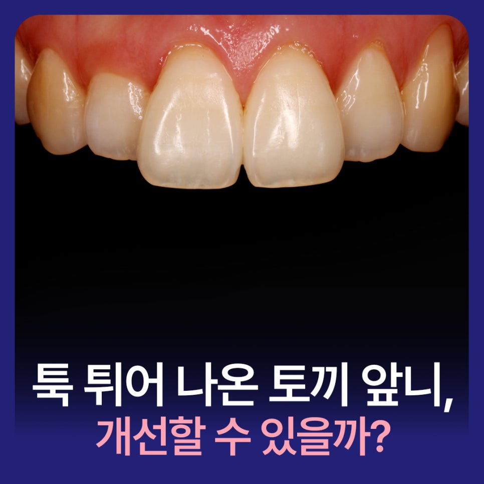툭 튀어 나온 토끼 앞니, 개선할 수 있을까? 관련 이미지 1