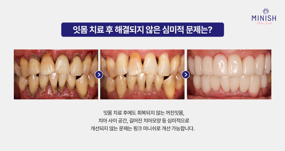 If Gum Swelling Continues, Suspect Periodontal Disease image 7
