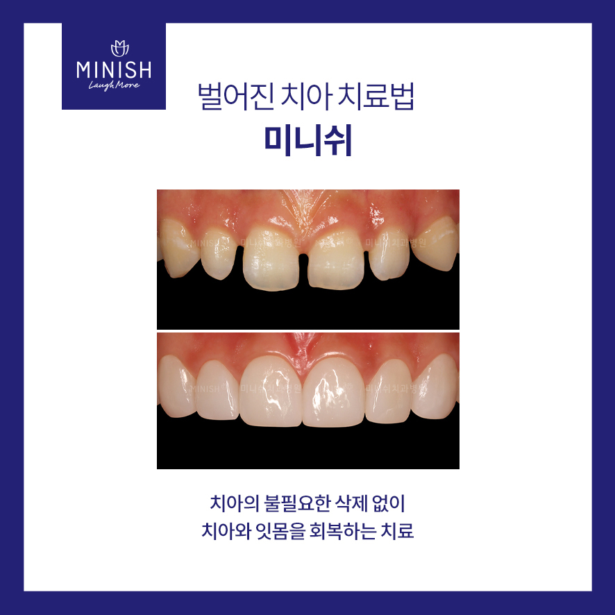 재미로 보는 치아 관상, 과연 내 치아는? 관련 이미지 6
