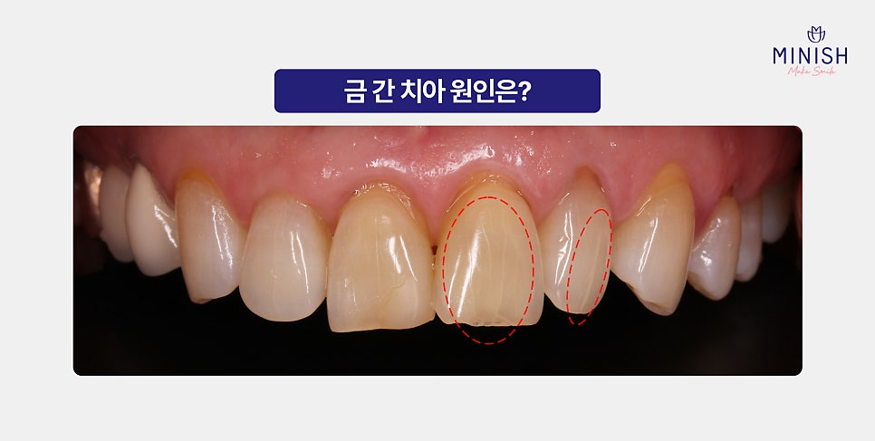 How Can Cracked Teeth Be Repaired Quickly and Healthily? A Complete Guide to Treatment Options image 2