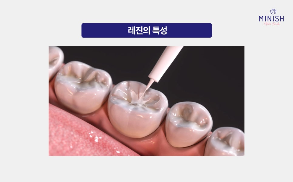 Key Points to Check Before Proceeding with Cavity Treatment Using Resin image 2