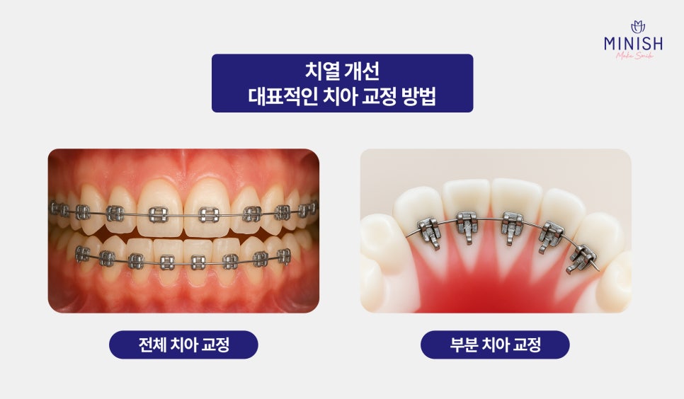 If You Want to Improve Irregular Teeth in Just One Day Without Orthodontics image 3