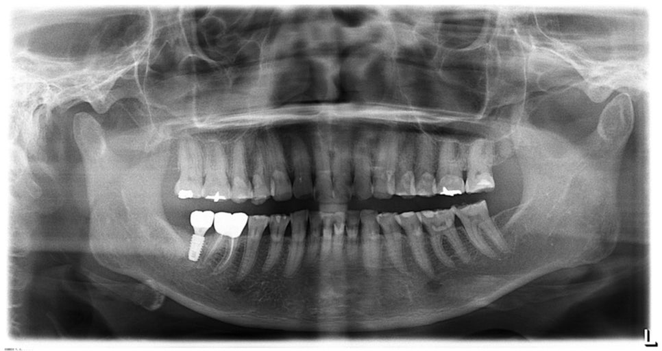 Why Choose Minish Instead of Crowns for Tooth Erosion After Overcoming Cancer? image 7