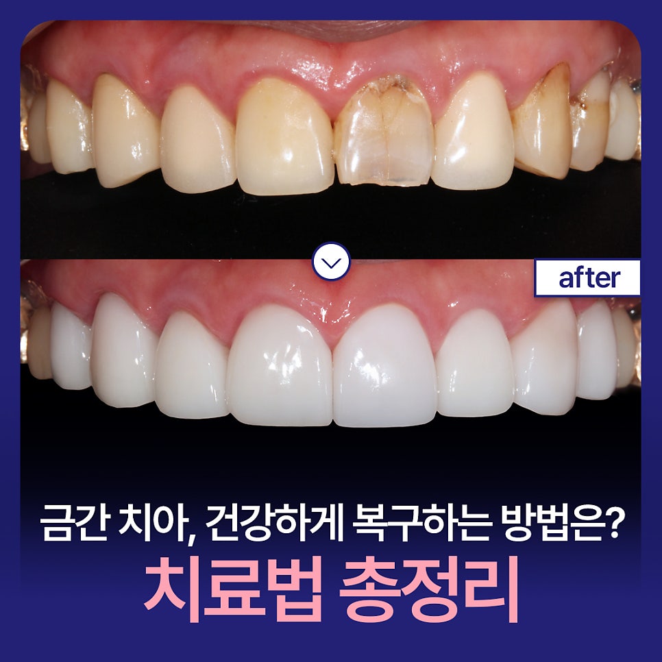How Can Cracked Teeth Be Repaired Quickly and Healthily? A Complete Guide to Treatment Options image 1