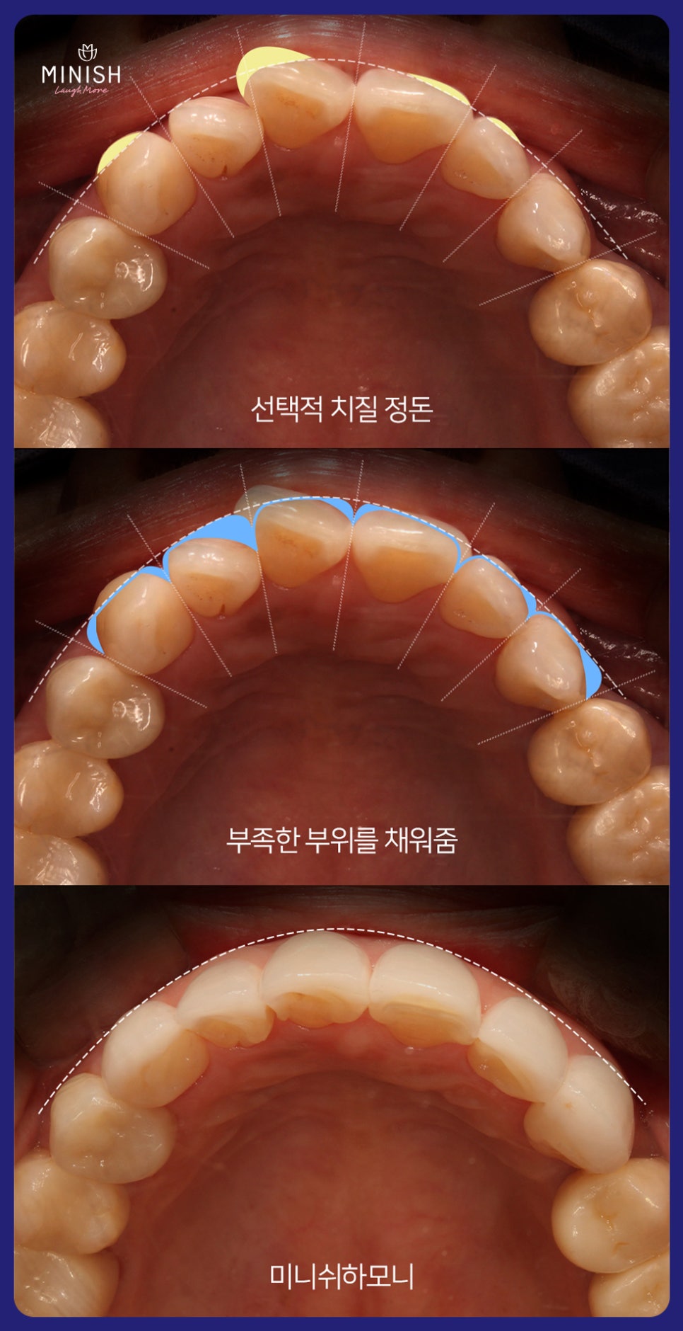 치아교정 고민, 미니쉬하모니로 관련 이미지 10