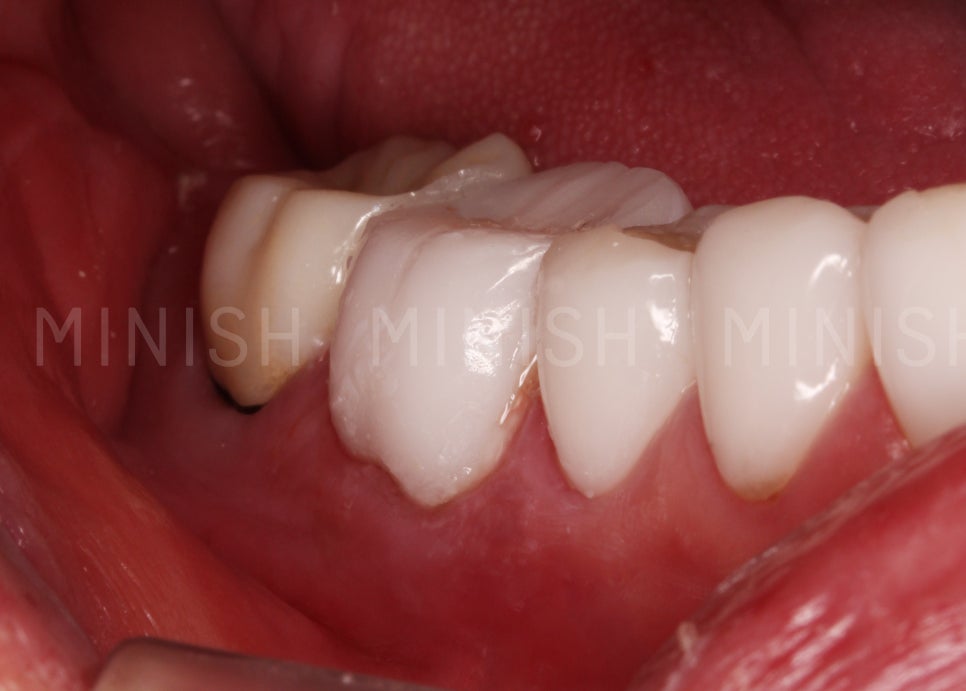 What’s the Difference Between Cosmetic Veneers and Treatment-Oriented Minishe? image 4