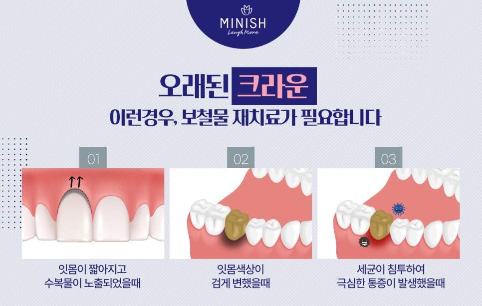 오래된 크라운 재치료가 시급하다면, 미니쉬치과 관련 이미지 3