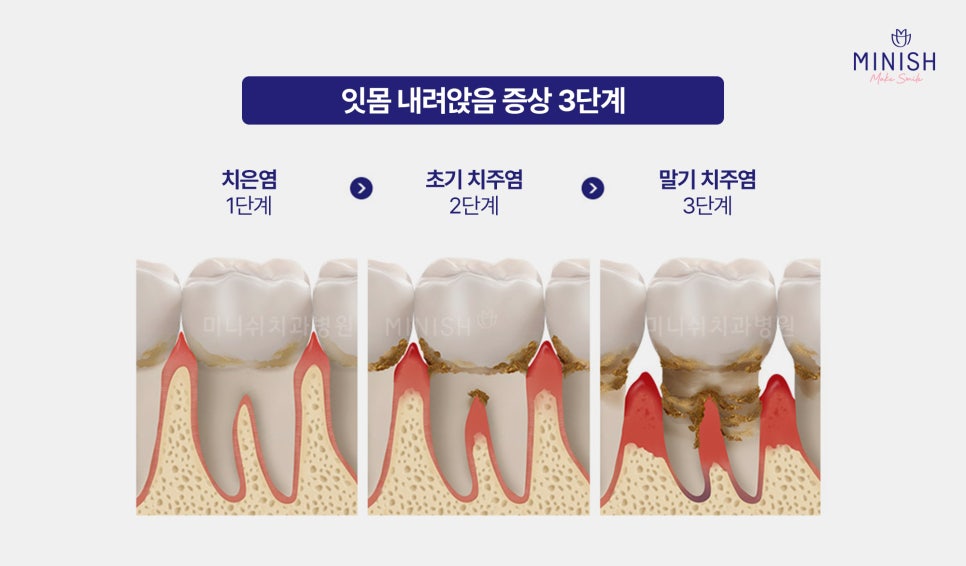 Worried About Gum Recession? Symptoms by Stage and Ways to Improve It image 3