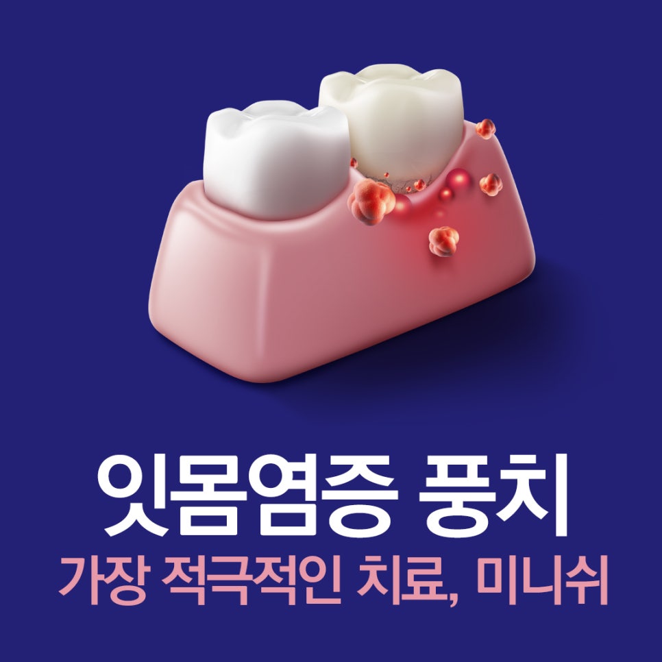 잇몸염증은 구강 적신호...가장 적극적인 잇몸치료는 미니쉬 관련 이미지 1