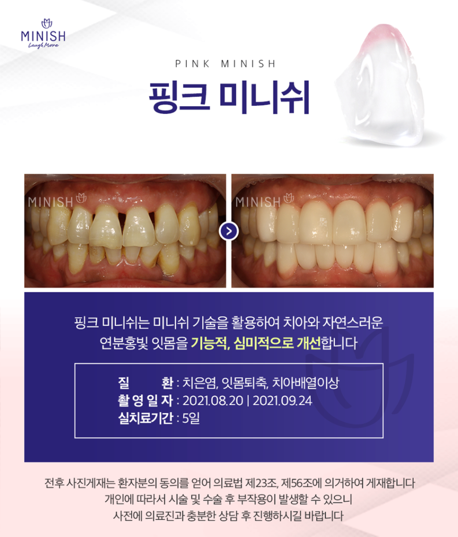 청담동치과 보다 정밀한 치아코팅으로 다양한 문제를 개선하는 미니쉬 관련 이미지 9