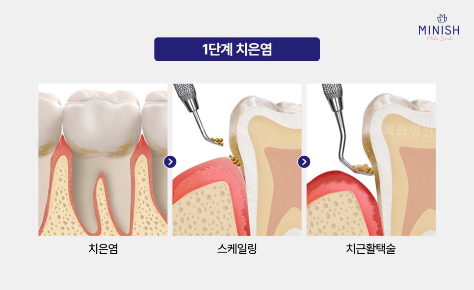 Bad Breath Causes: Could They Be More Serious Than You Think? A Summary of Solutions! image 5