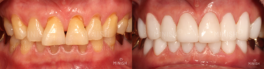[Tooth Aging] Do Teeth Age, Too? Restoring Them Healthily with Minishe image 10