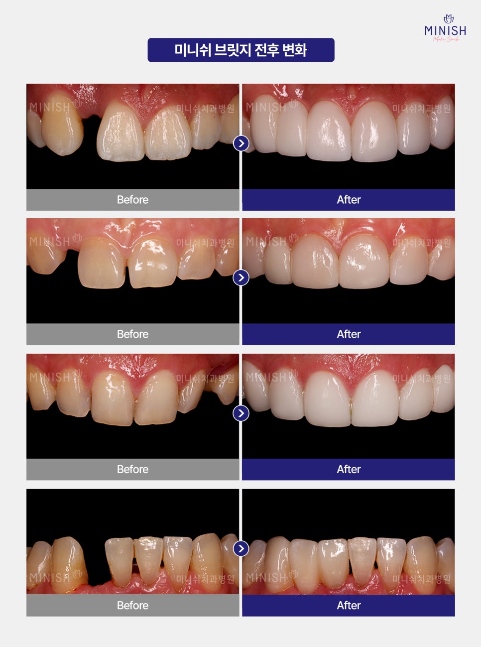 How Can You Restore Healthy Teeth After Tooth Loss Without Surgery? image 5