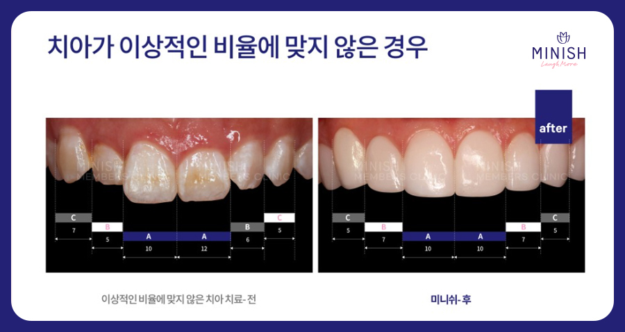 치아교정 고민, 미니쉬하모니로 관련 이미지 8