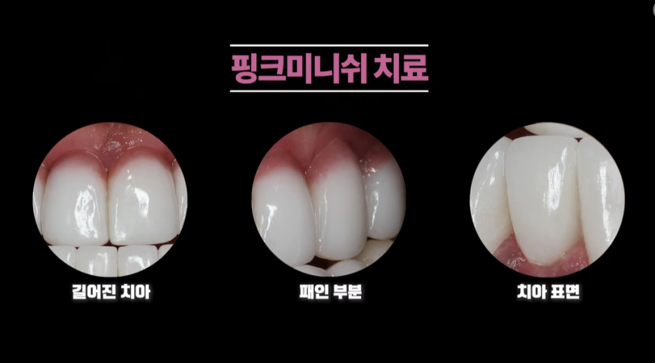 잇몸염증은 구강 적신호...가장 적극적인 잇몸치료는 미니쉬 관련 이미지 20