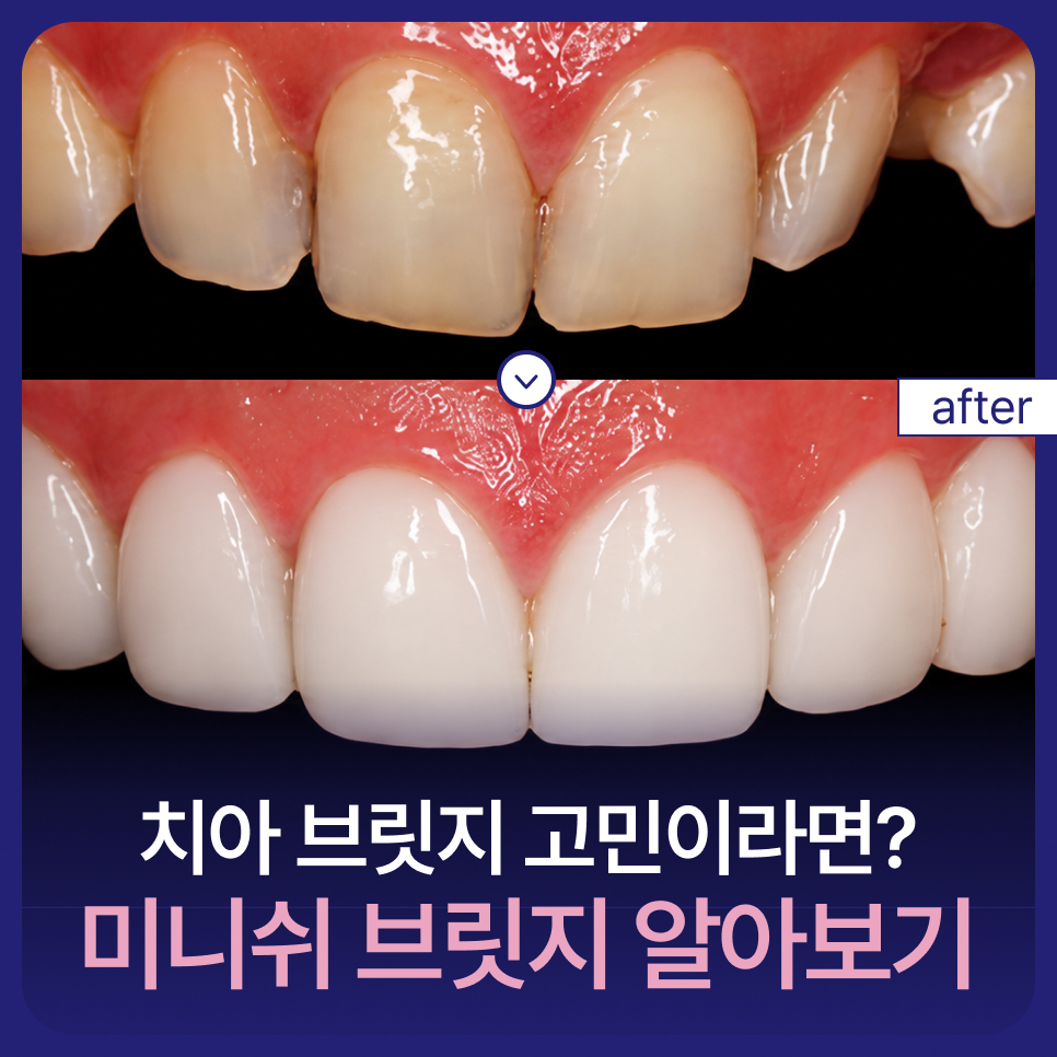치아 브릿지, 자연치아를 보존하는 미니쉬 브릿지 관련 이미지 1