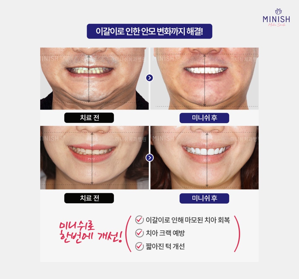 이갈이로 인한 치아마모, 미니쉬로 해결하세요! 관련 이미지 8