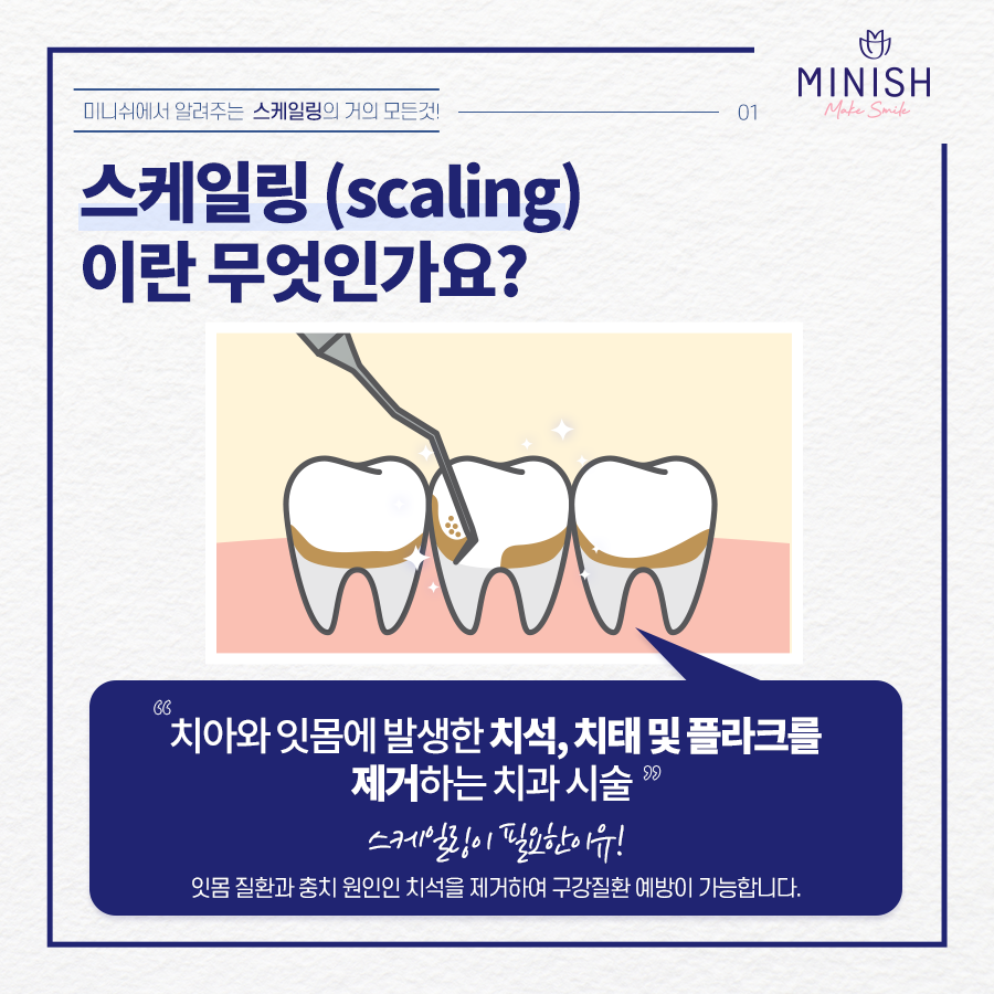 치과 스케일링의 거의 모든 것 관련 이미지 2