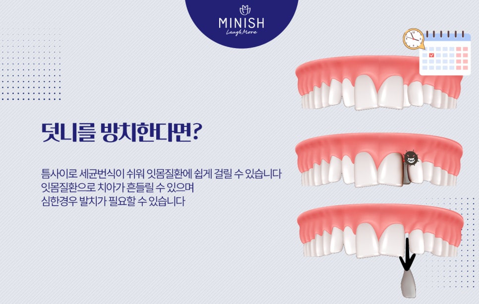 덧니교정, 왜 바로 잡아야 할까요? 관련 이미지 6