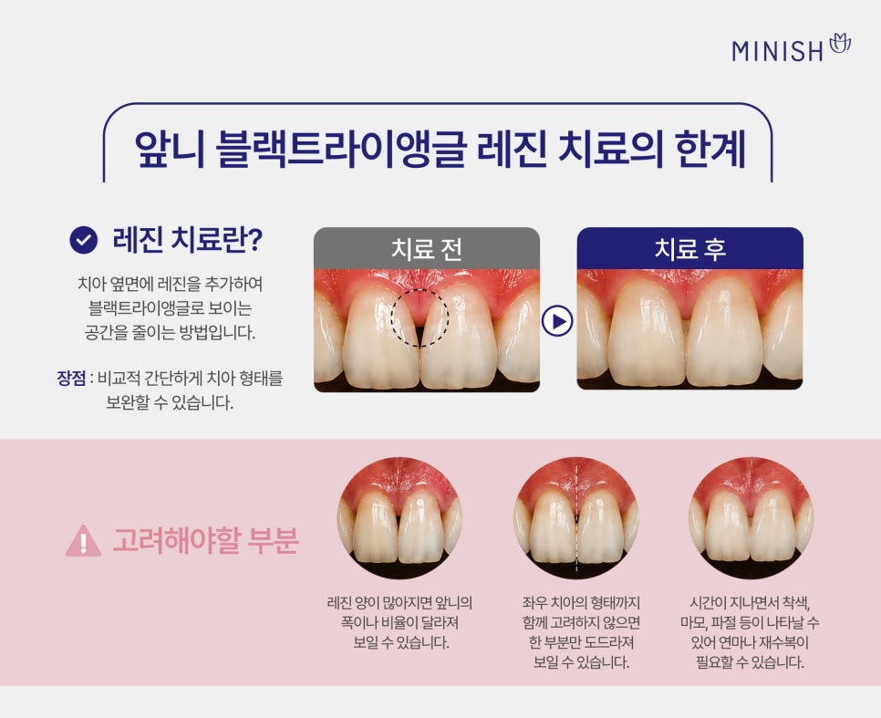 앞니 블랙트라이앵글 증상 원인, 레진 치료 한계와 미니쉬 관련 이미지 4