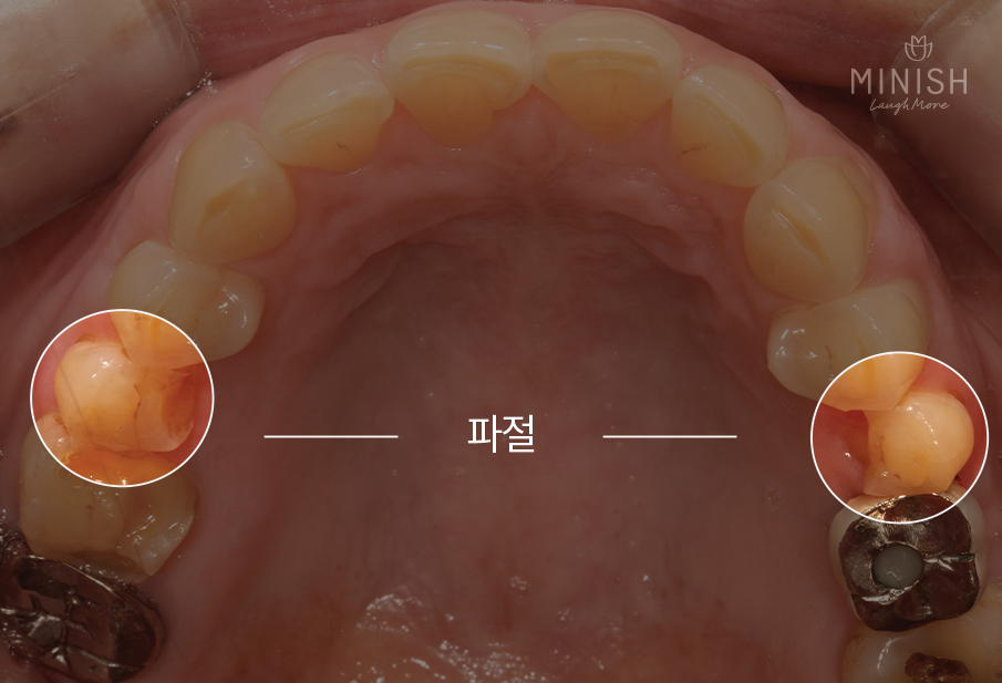 천안엄마의 치아노화, 미니쉬로 치아코팅하다 [엄마는예뻤다] 관련 이미지 10