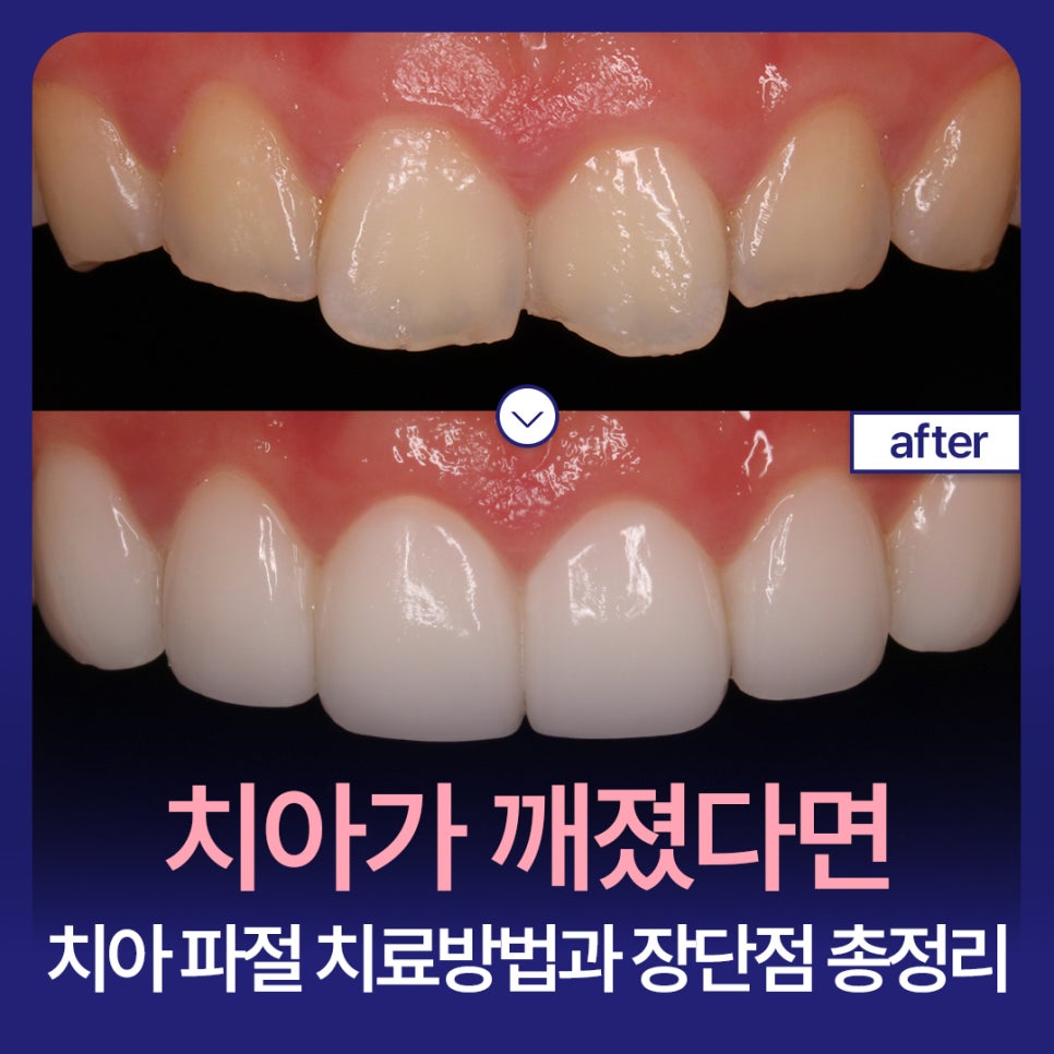 What If a Tooth Breaks? A Complete Summary of Tooth Fracture Treatment Methods and Their Pros and Cons image 1