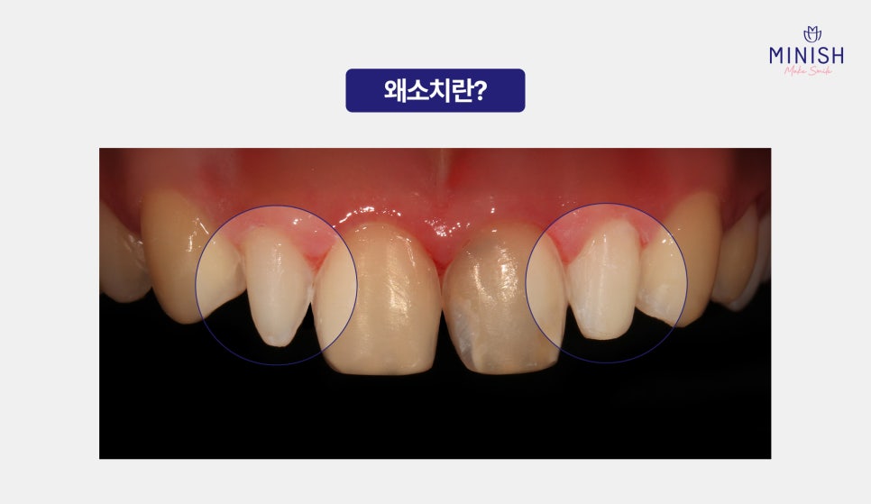 Problems That Occur If Small Teeth (Microdontia) Are Left Untreated! Treatment Methods Too! image 2