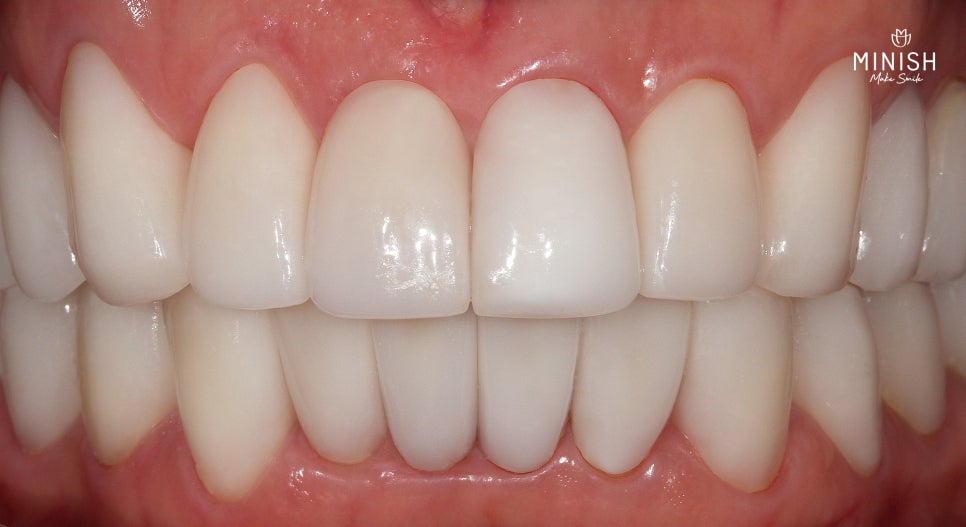 암 극복 후 마주한 치아 부식, 크라운 대신 미니쉬를 선택한 이유는? 관련 이미지 11