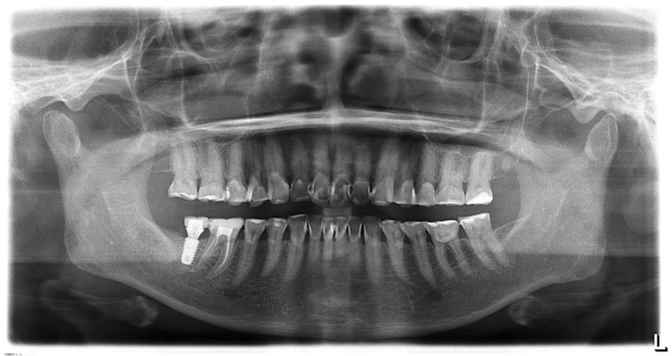 암 극복 후 마주한 치아 부식, 크라운 대신 미니쉬를 선택한 이유는? 관련 이미지 8