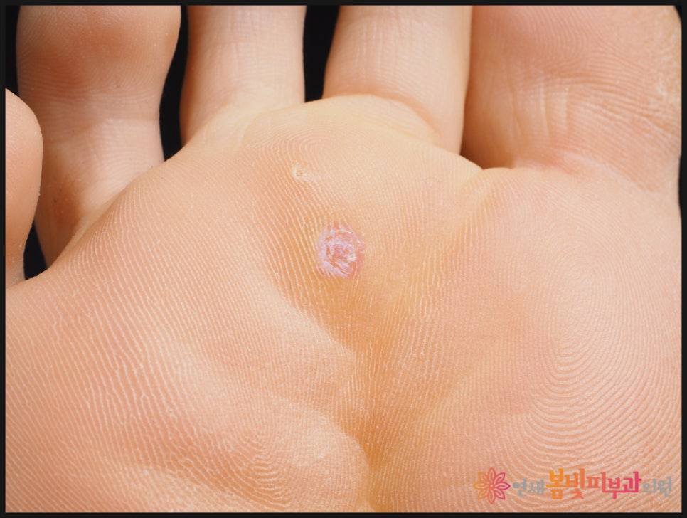 바이러스성 사마귀는 왜 자꾸 생길까요? (보통 사마귀, 편평 사마귀, 손발바닥 사마귀, 냉동치료,  블레오마이신 주사 치료, 레이저 치료) 관련 이미지 7