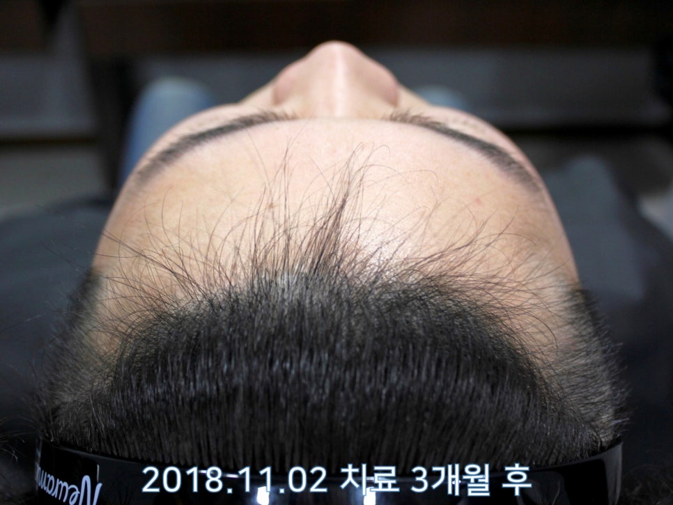 연세봄빛피부과 탈모치료 #15 (남성형탈모, 이마탈모, 정수리탈모) 관련 이미지 4