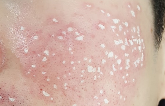 모공줄이는 방법 #2 (정상 모공과 넓어진 모공의 차이, 모공이 넓어지는 원인, 시크릿 레이저, 물광주사, 나노 크로스) 관련 이미지 6