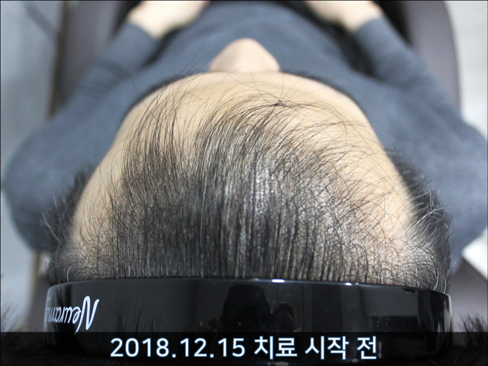 연세봄빛피부과 탈모치료 #36 (남성형탈모, 이마탈모, 3개월) 관련 이미지 1