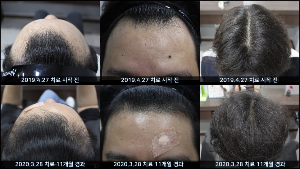 연세봄빛피부과 탈모치료 #42 (남성형탈모,M자탈모) 관련 이미지 14