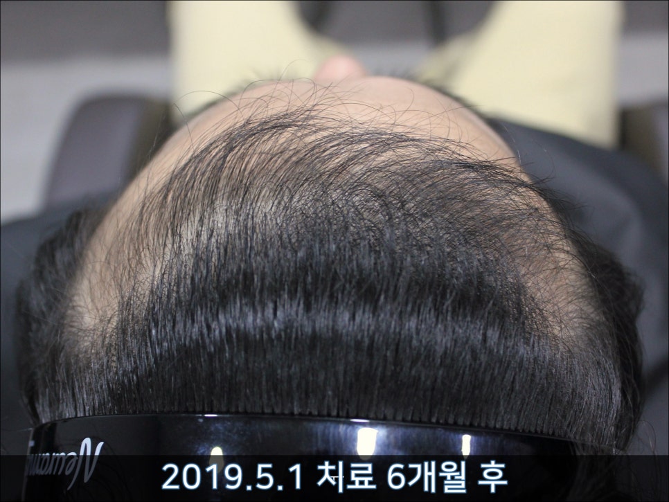 연세봄빛피부과 탈모치료 #33 (남성형탈모, 이마탈모, 정수리탈모, 가족력없음) 관련 이미지 5